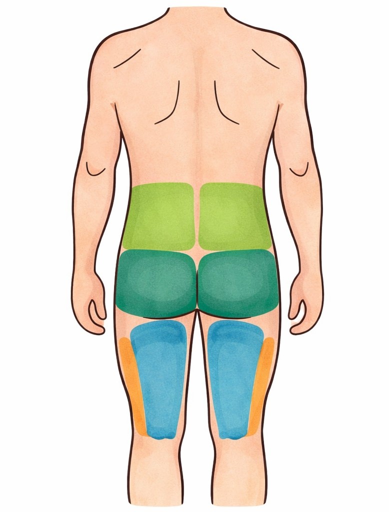 腰椎小關節症候群的轉移痛範圍圖，顯示疼痛延伸至臀部與大腿後側的常見區域。