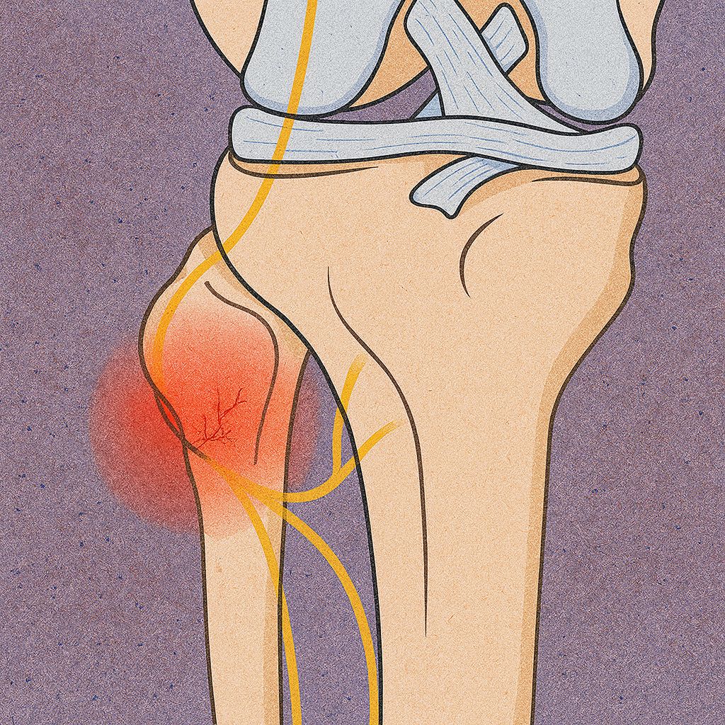 糖尿病腳麻、火燒痛還有救嗎?神經解套與肉毒 (Botox) 除痛新選擇 - 第2張圖 膝關節神經解剖醫學插圖,顯示黃色周邊神經路徑與紅色發炎區,解釋雙重夾擊症候群(Double Crush Syndrome)造成的神經卡壓。