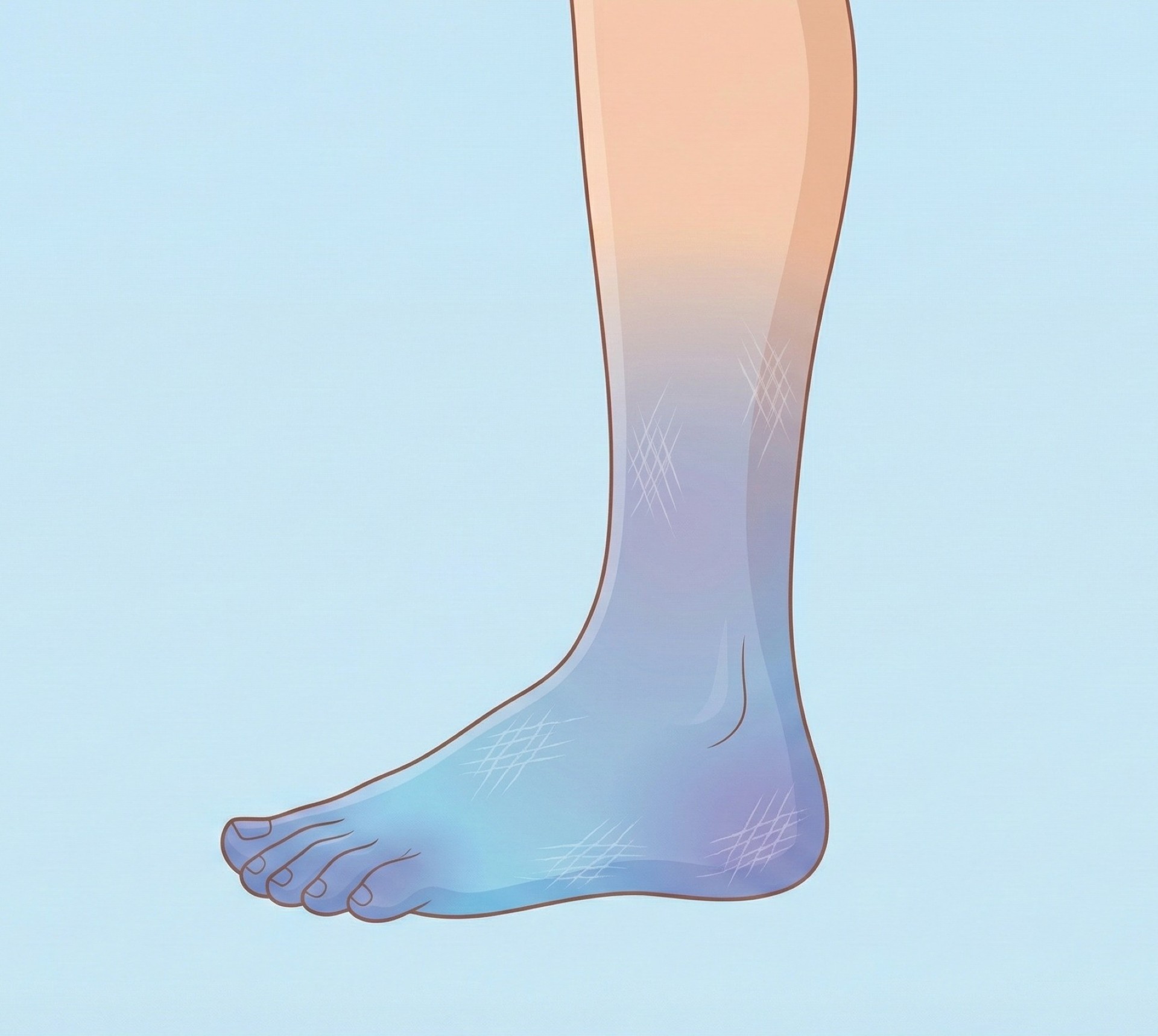 糖尿病周邊神經病變襪套式麻木範圍圖解